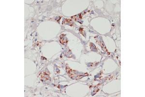 Immunohistochemistry of paraffin-embedded human mammary cancer using  antibody (ABIN6129863, ABIN6136456, ABIN6136457 and ABIN6215371) at dilution of 1:100 (40x lens).