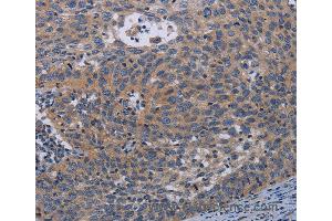 Immunohistochemistry of Human cervical cancer using PAPPA Polyclonal Antibody at dilution of 1:50 (PAPPA anticorps)