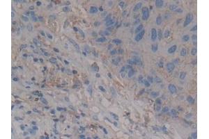 Detection of SDC1 in Human Lung cancer Tissue using Polyclonal Antibody to Syndecan 1 (SDC1) (Syndecan 1 anticorps  (AA 23-253))