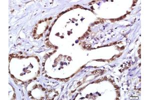 Paraformaldehyde-fixed, paraffin embedded human gastric cancer, Antigen retrieval by boiling in sodium citrate buffer (pH6. (PCNA anticorps  (AA 201-261))