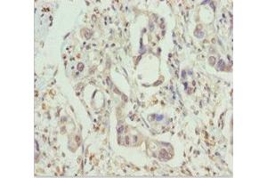 Immunohistochemistry of paraffin-embedded human pancreatic cancer using ABIN7161805 at dilution of 1:100