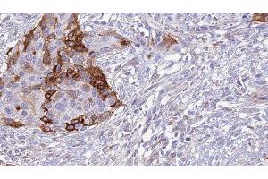 ABIN6277025 at 1/100 staining Human urothelial cancer tissue by IHC-P.