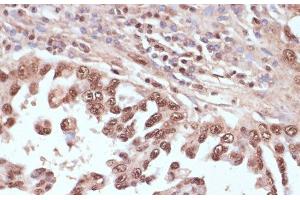 Immunohistochemistry of paraffin-embedded Human lung cancer using RAD50 Polyclonal Antibody at dilution of 1:100 (40x lens).