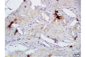 Formalin-fixed and paraffin embedded human cervical carcinoma labeled with Anti-CD72/Ly-32 Polyclonal Antibody, Unconjugated (ABIN741420) at 1:200 followed by conjugation to the secondary antibody and DAB staining (CD72 anticorps  (AA 4-110))