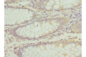 Immunohistochemistry of paraffin-embedded human colon cancer using ABIN7163515 at dilution of 1:100 (ATP2B2 anticorps  (AA 1-80))