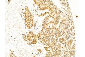ABIN6255488 and ABIN6267309 at 1/100 staining Human lung cancer by IHC-P.