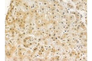 ABIN6262356 and ABIN6272323 at 1/100 staining human hepatocellular carcinoma by IHC-P. (HOXD8 anticorps  (Internal Region))