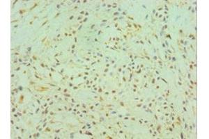 Immunohistochemistry of paraffin-embedded human breast cancer using ABIN7147014 at dilution of 1:100 (Cathepsin K anticorps  (AA 115-329))