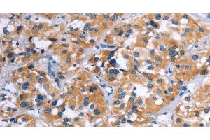 Immunohistochemistry of paraffin-embedded Human thyroid cancer using COMP Polyclonal Antibody at dilution of 1:50