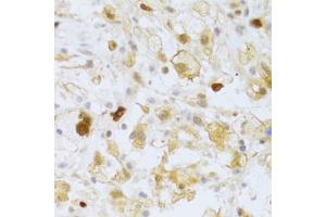 Immunohistochemistry of paraffin-embedded human brain astrocytoma using FCN1 Antibody (ABIN5973958) at dilution of 1/100 (40x lens). (FCN1 anticorps)