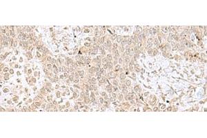 Immunohistochemistry of paraffin-embedded Human ovarian cancer tissue using RPL35 Polyclonal Antibody at dilution of 1:70(x200) (RPL35 anticorps)