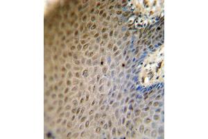 SREBF2 antibody (Center) (ABIN654630 and ABIN2844326) immunohistochemistry analysis in formalin fixed and paraffin embedded human skin carcinoma followed by peroxidase conjugation of the secondary antibody and DAB staining.