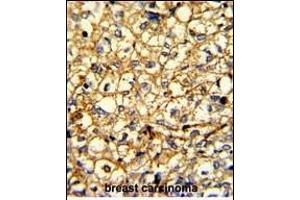 Formalin-fixed and paraffin-embedded human breast carcinoma with ADRA2B Antibody (Center), which was peroxidase-conjugated to the secondary antibody, followed by DAB staining.