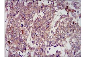 Immunohistochemical analysis of paraffin-embedded bladder cancer tissues using IGF2 mouse mAb with DAB staining.