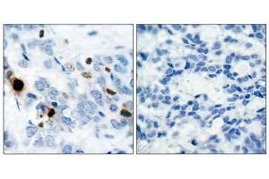 Immunohistochemical analysis of paraffin-embedded human breast carcinoma tissue using Histone H3. (Histone H3.1 anticorps  (pSer10))