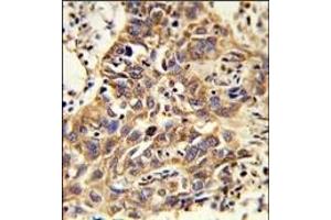 Formalin-fixed and paraffin-embedded human lung carcinoma reacted with CAT Antibody (Center), which was peroxidase-conjugated to the secondary antibody, followed by DAB staining.