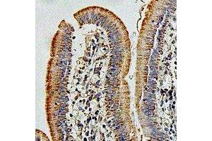 Immunohistochemical analysis of HIP1 staining in human colon cancer formalin fixed paraffin embedded tissue section.