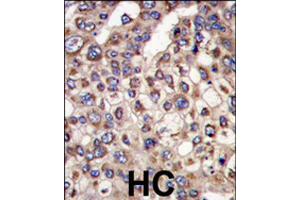 Formalin-fixed and paraffin-embedded human hepatocellular carcinoma reacted with MTMR4 polyclonal antibody  , which was peroxidase-conjugated to the secondary antibody, followed by DAB staining . (MTMR4 anticorps  (C-Term))