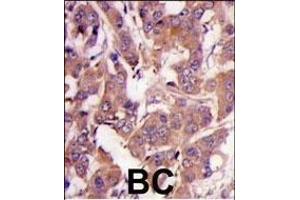 Formalin-fixed and paraffin-embedded human breast carcinoma tissue reacted with MEK1 Antibody (N-term) (ABIN1882177 and ABIN2842020) , which was peroxidase-conjugated to the secondary antibody, followed by DAB staining. (MEK1 anticorps  (N-Term))