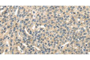 Immunohistochemistry of paraffin-embedded Human esophagus cancer tissue using RASA2 Polyclonal Antibody at dilution 1:45 (RASA2 anticorps)