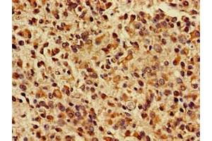 Immunohistochemistry of paraffin-embedded human glioma using ABIN7157603 at dilution of 1:100 (KIF17 anticorps  (AA 500-777))