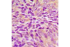 Immunohistochemical analysis of GRP75 staining in human breast cancer formalin fixed paraffin embedded tissue section.
