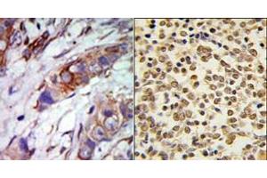 (LEFT)Formalin-fixed and paraffin-embedded human cancer tissue reacted with the primary antibody, which was peroxidase-conjugated to the secondary antibody, followed by AEC staining.