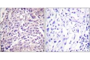 Immunohistochemistry analysis of paraffin-embedded human breast carcinoma tissue, using FOXO1A (Ab-329) Antibody. (FOXO1 anticorps  (AA 295-344))