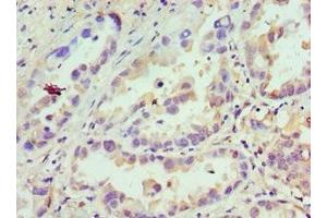 Immunohistochemistry of paraffin-embedded human lung cancer using ABIN7145712 at dilution of 1: 100 (CDCA8 anticorps  (AA 1-280))