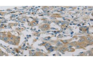 Immunohistochemistry of paraffin-embedded Human breast cancer using MAP2K6 Polyclonal Antibody at dilution of 1:30 (MAP2K6 anticorps)