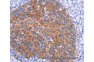 Immunohistochemistry of Human thyroid cancer using PTPN13 Polyclonal Antibody at dilution of 1:30 (PTPN13 anticorps)