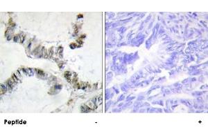 Immunohistochemistry analysis of paraffin-embedded human colon carcinoma tissue, using HMGXB3 polyclonal antibody . (HMGXB3 anticorps)