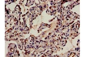 Immunohistochemistry analysis of human lung cancer using ABIN7145820 at dilution of 1:100