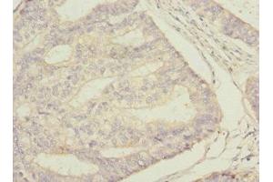 Immunohistochemistry of paraffin-embedded human endometrial cancer using ABIN7169694 at dilution of 1:100 (STAM2 anticorps  (AA 376-525))