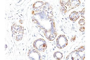 Formalin-fixed, paraffin-embedded human Breast Carcinoma stained with SM-MHC Monoclonal Antibody (SMMS-1). (MYH11 anticorps)