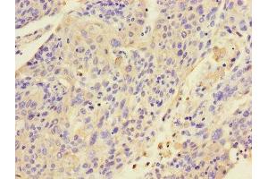 Immunohistochemistry of paraffin-embedded human cervical cancer using ABIN7157424 at dilution of 1:100