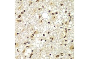 Immunohistochemistry of paraffin-embedded human brain cancer using ZNF20 antibody (ABIN5975115) at dilution of 1/100 (40x lens). (ZNF20 anticorps)