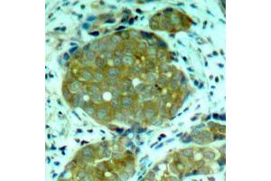 Immunohistochemistry of paraffin-embedded human breast carcinoma using Phospho-NFKB1-S932 antibody (ABIN2988211). (NFKB1 anticorps  (pSer932))