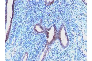 Formalin-fixed, paraffin-embedded human Endometrial Carcinoma stained with Cyclin B1 Mouse Monoclonal Antibody (CCNB1/1098). (Cyclin B1 anticorps)