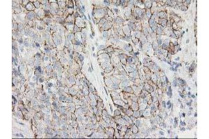 Immunohistochemical staining of paraffin-embedded Adenocarcinoma of Human breast tissue using anti-ANAPC2 mouse monoclonal antibody. (ANAPC2 anticorps)