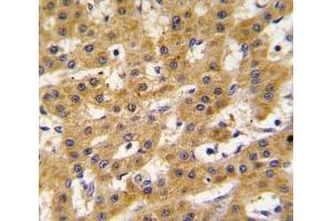 IHC analysis of FFPE human hepatocarcinoma tissue stained with PDX1 antibody