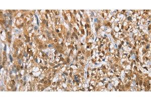 Immunohistochemistry of paraffin-embedded Human esophagus cancer tissue using MMP12 Polyclonal Antibody at dilution of 1:60 (MMP12 anticorps)