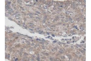 DAB staining on IHC-P; Samples: Human Lung cancer Tissue (MRPL1 anticorps  (AA 147-285))