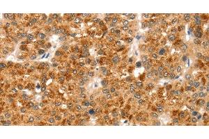 Immunohistochemistry of paraffin-embedded Human liver cancer using CCS Polyclonal Antibody at dilution of 1:35 (Superoxide dismutase copper chaperone anticorps)