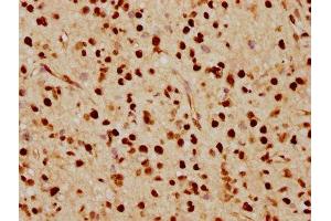 IHC image of ABIN7127502 diluted at 1:70 and staining in paraffin-embedded human glioma cancer performed on a Leica BondTM system.