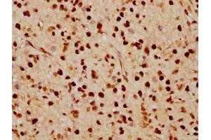 IHC image of ABIN7127502 diluted at 1:70 and staining in paraffin-embedded human glioma cancer performed on a Leica BondTM system. (Recombinant FTO anticorps)
