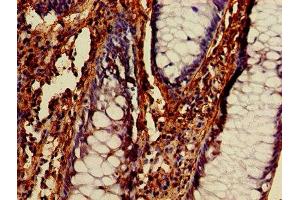 IHC image of ABIN7145343 diluted at 1:400 and staining in paraffin-embedded human colon cancer performed on a Leica BondTM system.