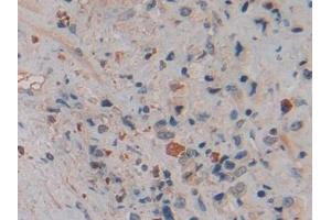 Detection of NGAL in Human Prostate cancer Tissue using Polyclonal Antibody to Neutrophil gelatinase-associated lipocalin (NGAL)