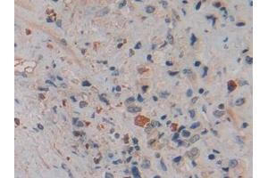 Detection of NGAL in Human Prostate cancer Tissue using Polyclonal Antibody to Neutrophil gelatinase-associated lipocalin (NGAL) (Lipocalin 2 anticorps  (AA 21-198))