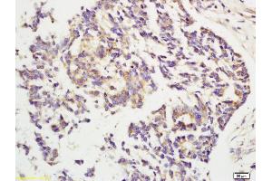 Formalin-fixed and paraffin embedded human rectal carcinoma labeled with Rabbit Anti CYP2E1 Polyclonal Antibody, Unconjugated (ABIN707141) at 1:200 followed by conjugation to the secondary antibody and DAB staining (CYP2E1 anticorps  (AA 401-493))